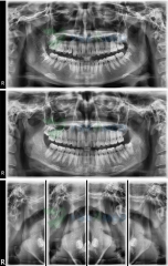 Цифровая панорамная рентгеновская система YSENMED для стоматологического применения с цефалометрией YSX1005C