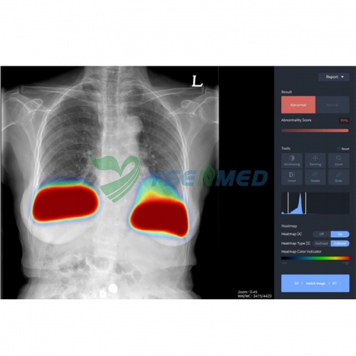 Medical Radiology Chest AI Diagnostic Software YSX-AI-C
