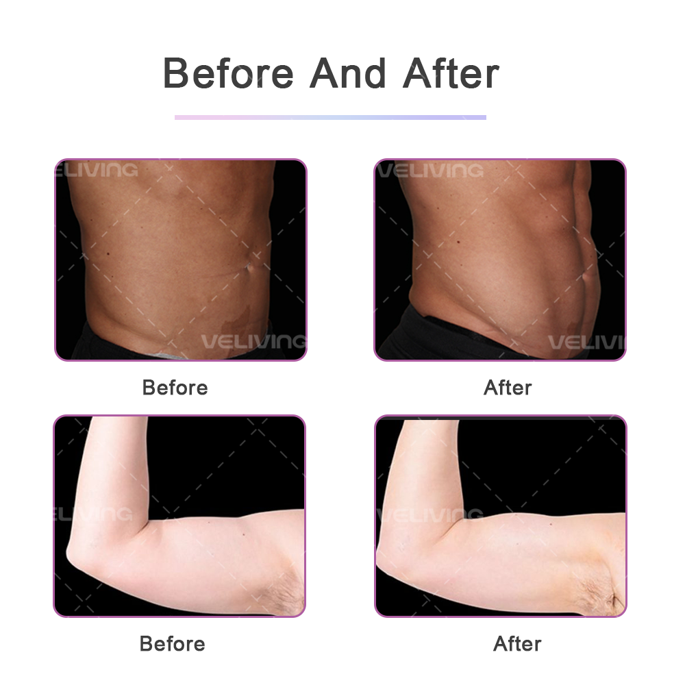 Portable 4 Handle EMslim Neo Portable Belly Fat Reducing Muscle Stimulation Body Sculpting Machine