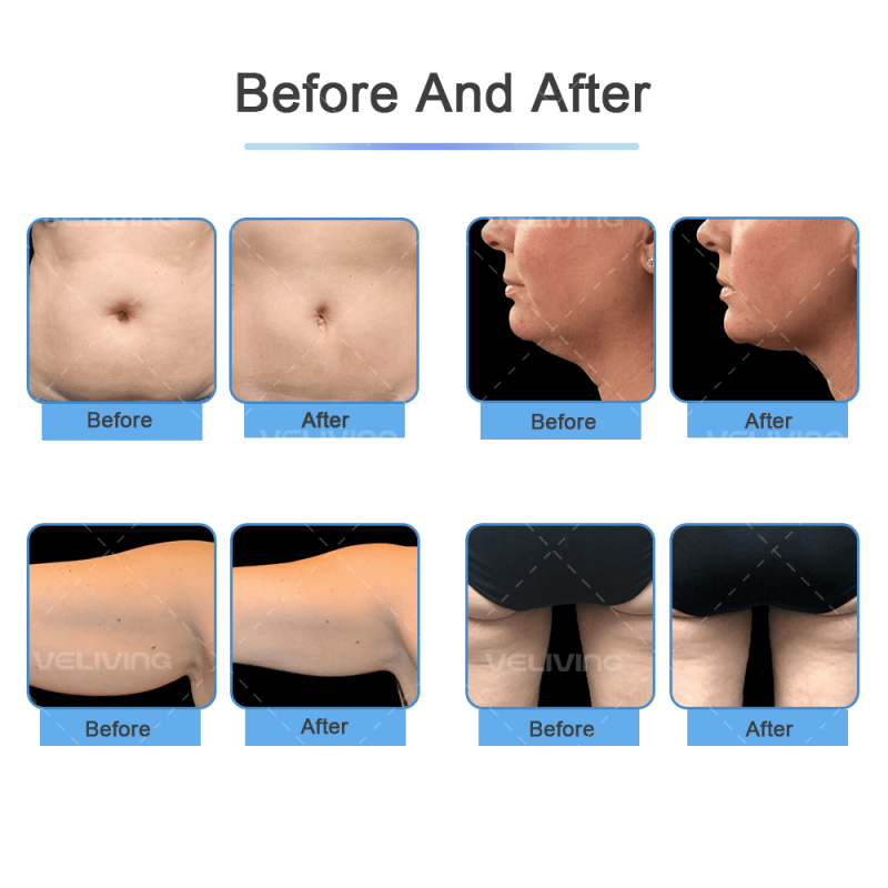 CRYOSCULPTING Fat Freezing Body Cavitation Machine With 6 Handles