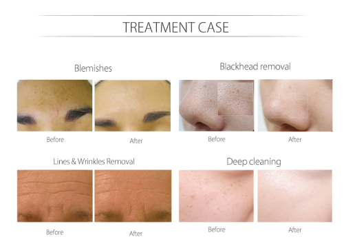 New Arrivals 10 in 1 Hydra Aqua Facial Machine With skin analyzer function