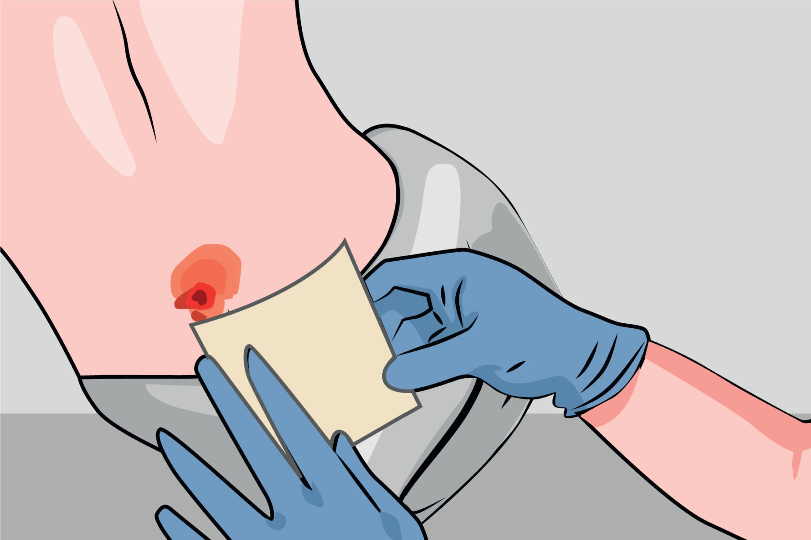 How to Choose the Suitable Wound Dressing