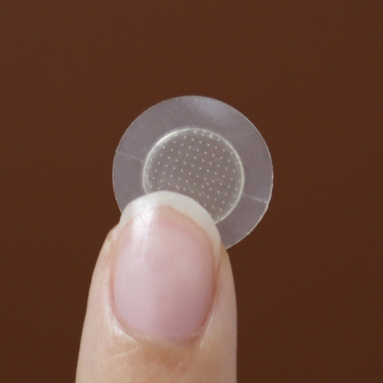 Dissolving Microneedle Acne Patch for Acne Treatment