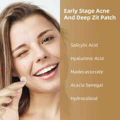 Dissolving Microneedle Acne Patch for Acne Treatment