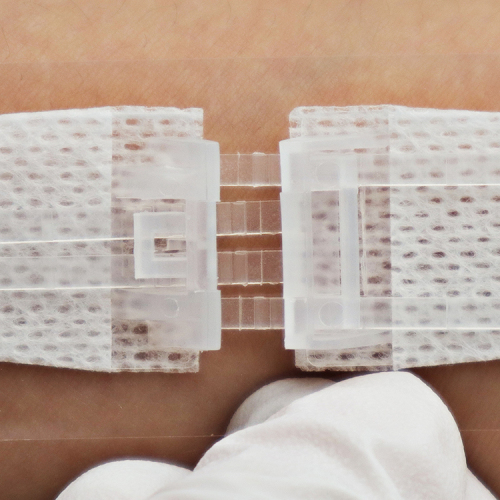 Wound Closure Device Single Type 1 Button,Wound Closure Device