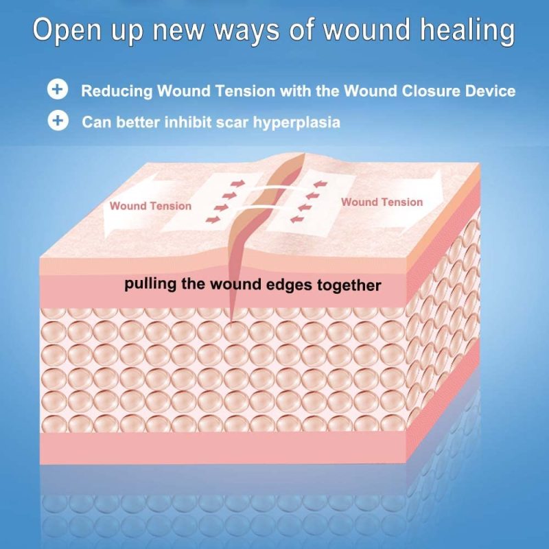 Non-Woven Surgical Wound Closure Device (White Color)