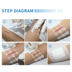 Elastic Hydrocolloid Wound Closure Device
