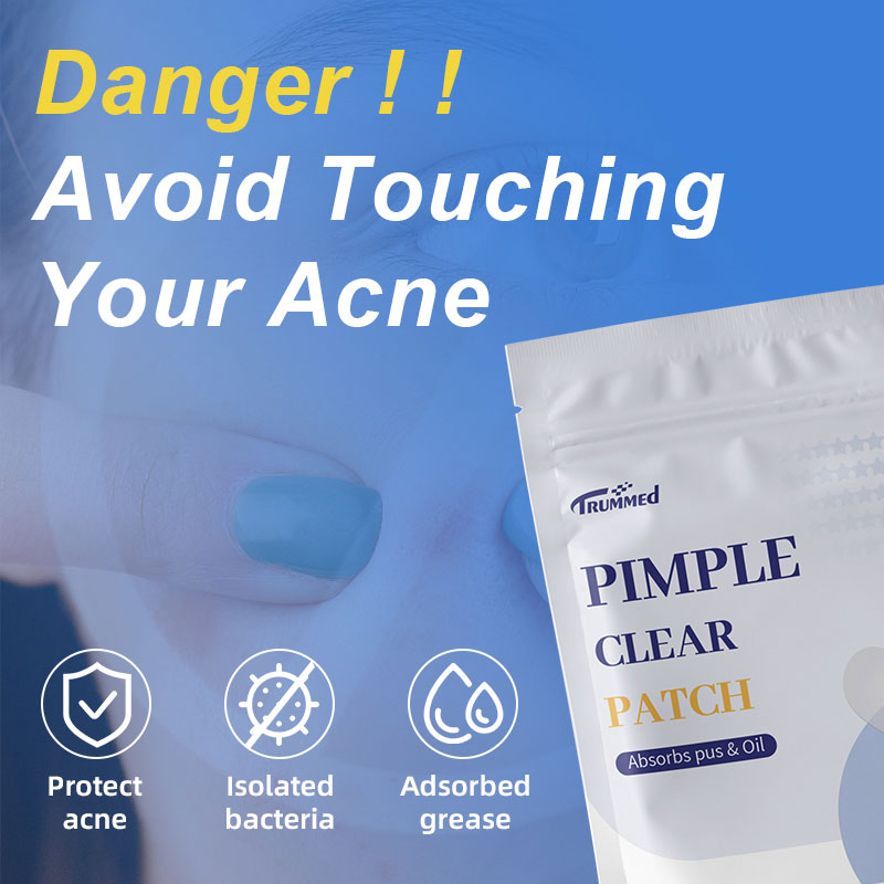 Danger! Avoid Touching Your Acne
