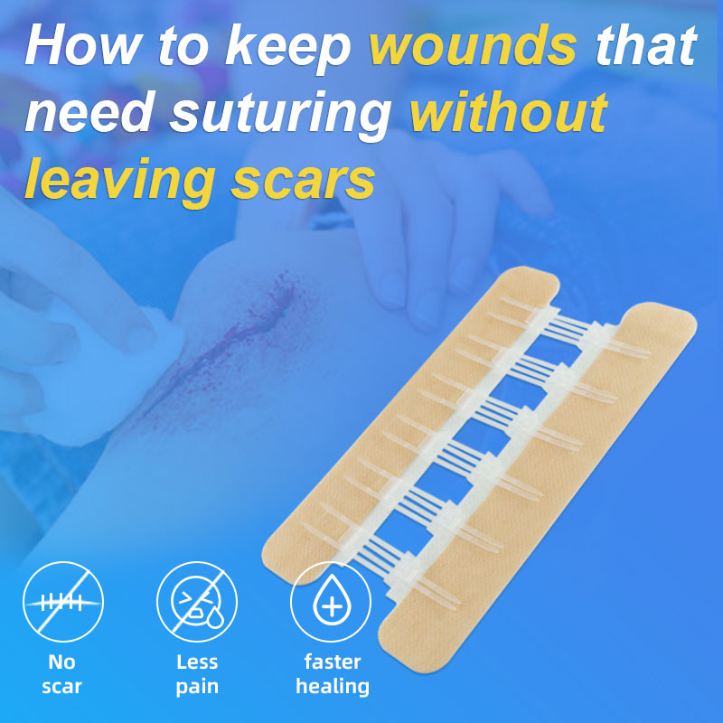 How to keep wounds that need suturing without leaving scars