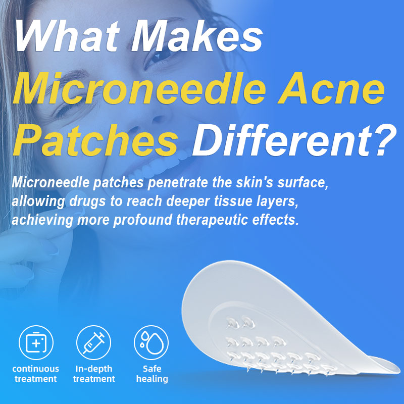 What Makes The Microneedle Acne Patches Different?