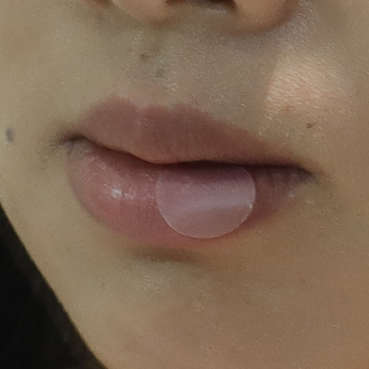 Trummed Cold Sore Patch Fever Blister Patch