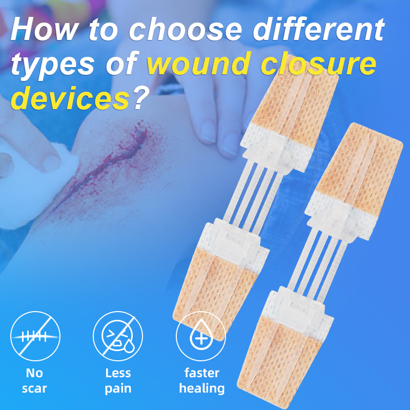 How to choose different types of wound closure devices?