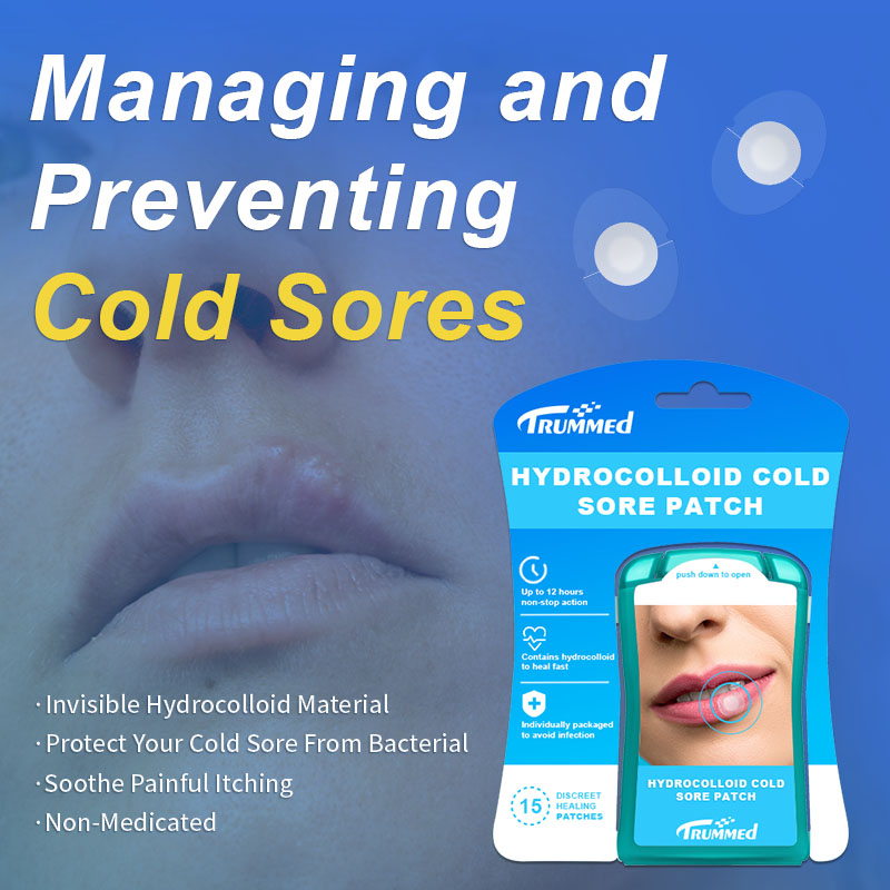 Managing and Preventing Cold Sores