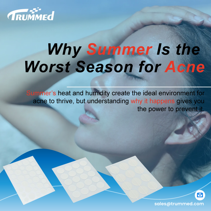 Why Summer Is the Worst Season for Acne