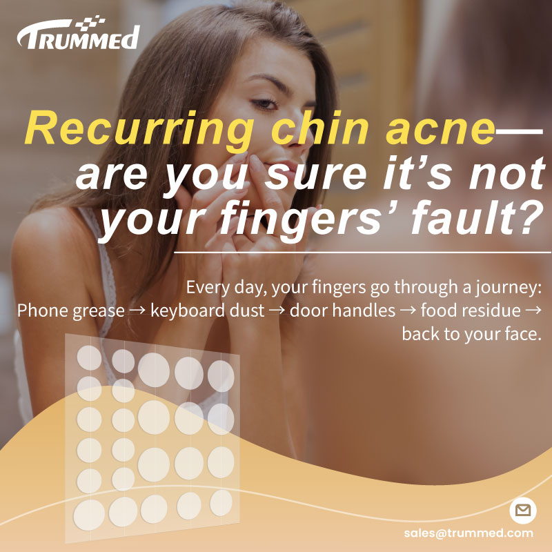 Recurring chin acne—are you sure it’s not your fingers’ fault?