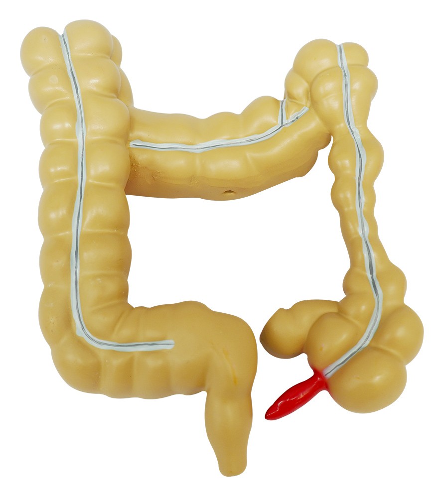 Human Colon Rectum Anatomy Model with Pathologies, Intestine Disease