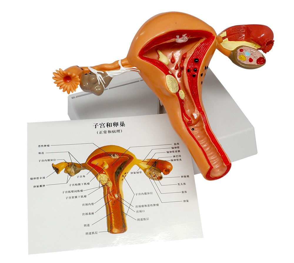 Uterus & Ovary Anatomy Model with Pathologies for Doctors Office Education