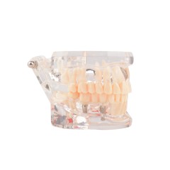 Implant Pathological Teeth Model with Restoration Bridge Tooth for Dental Disease Education