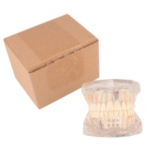 Implant Pathological Teeth Model with Restoration Bridge Tooth for Dental Disease Education