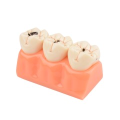 Tooth Decay Evolution Model - 4 Times Dental Caries for Teaching