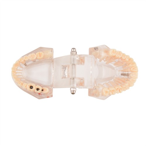 Implant Pathological Teeth Model with Restoration Bridge Tooth for Dental Disease Education