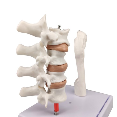 Menopausal Osteoporosis Model (Femur & 4 Vertebrae) for Medical Teaching