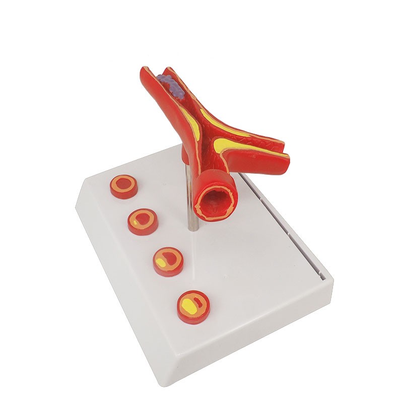 Arteriosclerosis Model, with Cross Section of Artery, 4 Part