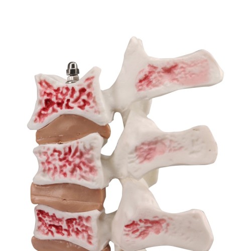 Menopausal Osteoporosis Model (Femur & 4 Vertebrae) for Medical Teaching