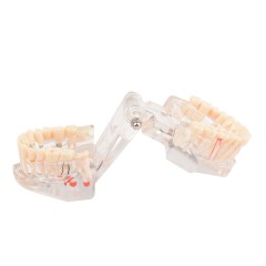 Implant Pathological Teeth Model with Restoration Bridge Tooth for Dental Disease Education