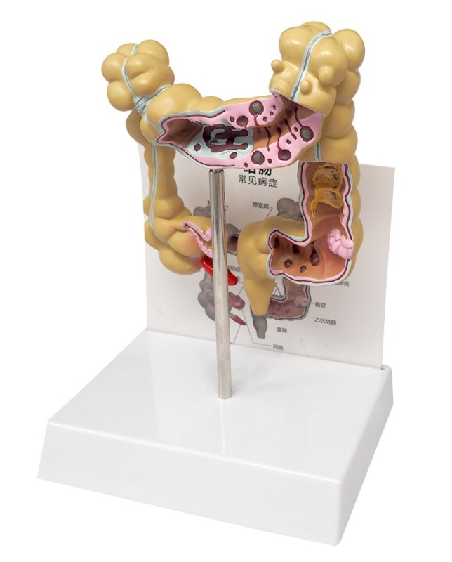 Human Colon Rectum Anatomy Model with Pathologies, Intestine Disease