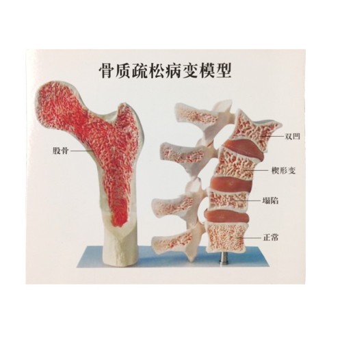 Menopausal Osteoporosis Model (Femur & 4 Vertebrae) for Medical Teaching