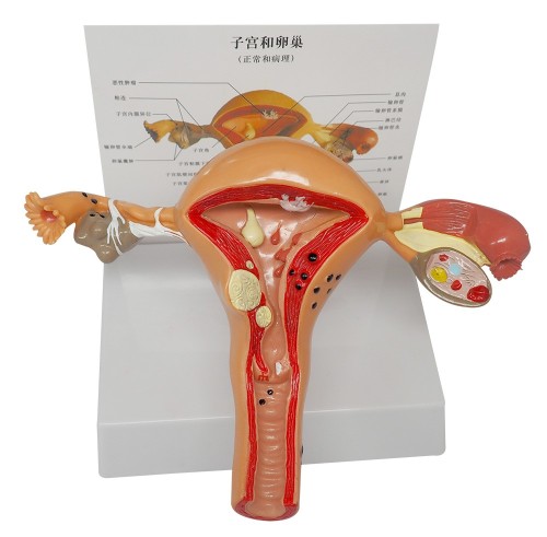 Uterus &amp; Ovary Anatomy Model with Pathologies for Doctors Office Education