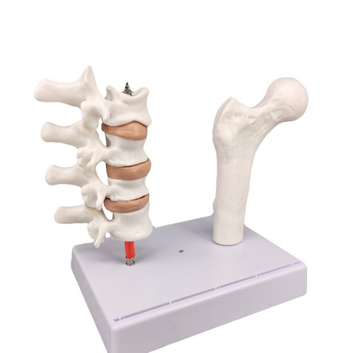 Menopausal Osteoporosis Model (Femur & 4 Vertebrae) for Medical Teaching