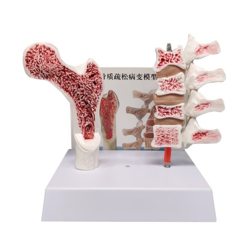 Menopausal Osteoporosis Model (Femur & 4 Vertebrae) for Medical Teaching