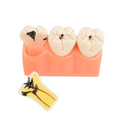Tooth Decay Evolution Model - 4 Times Dental Caries for Teaching