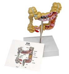 Human Colon Rectum Anatomy Model with Pathologies, Intestine Disease