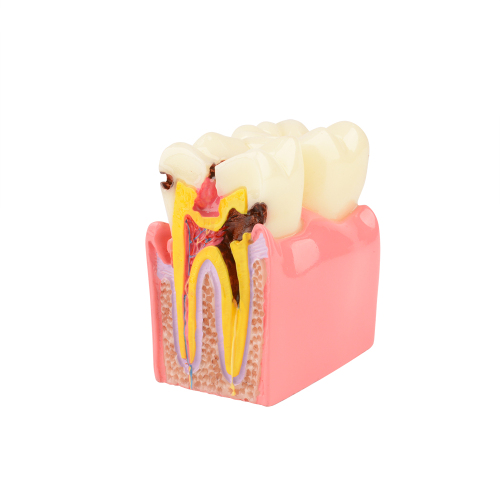 Dental Teeth Decay Model, 6 Times Caries, Comparative Study for Dentist