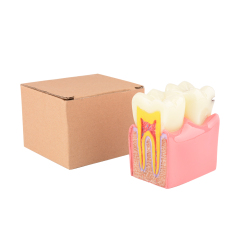 Dental Teeth Decay Model, 6 Times Caries, Comparative Study for Dentist