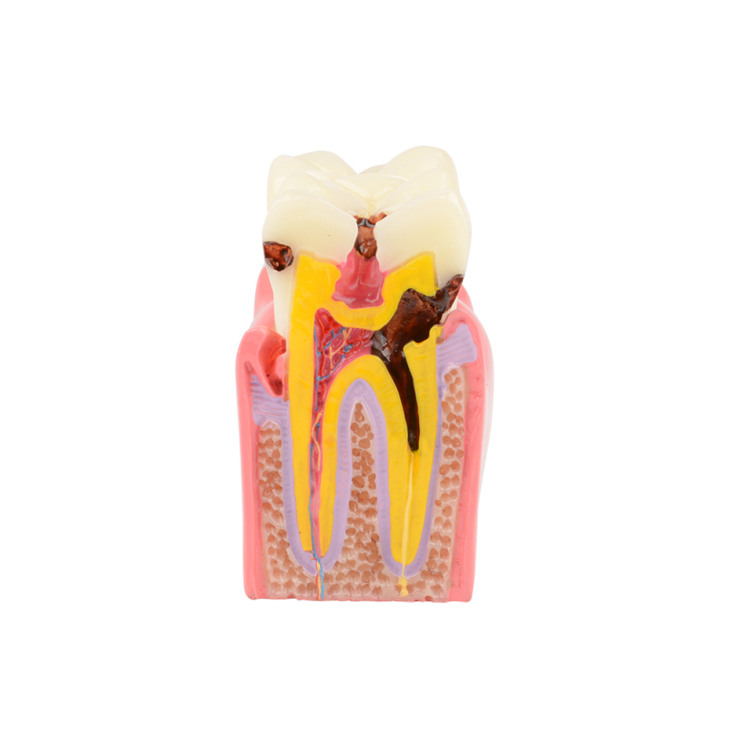 Dental Teeth Decay Model, 6 Times Caries, Comparative Study for Dentist