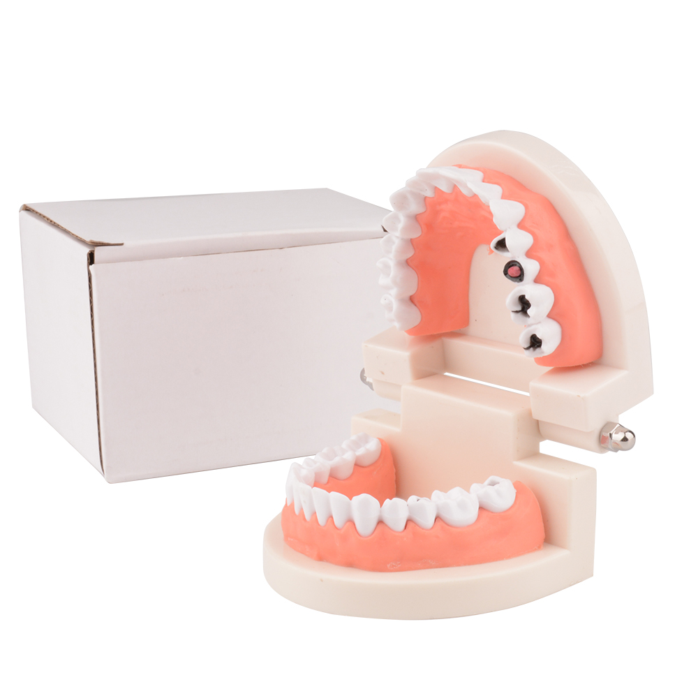 Standard Dental Tooth Decay Study Model, 1:1 Life Size Child