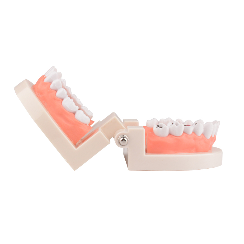 Standard Dental Tooth Decay Study Model, 1:1 Life Size Child
