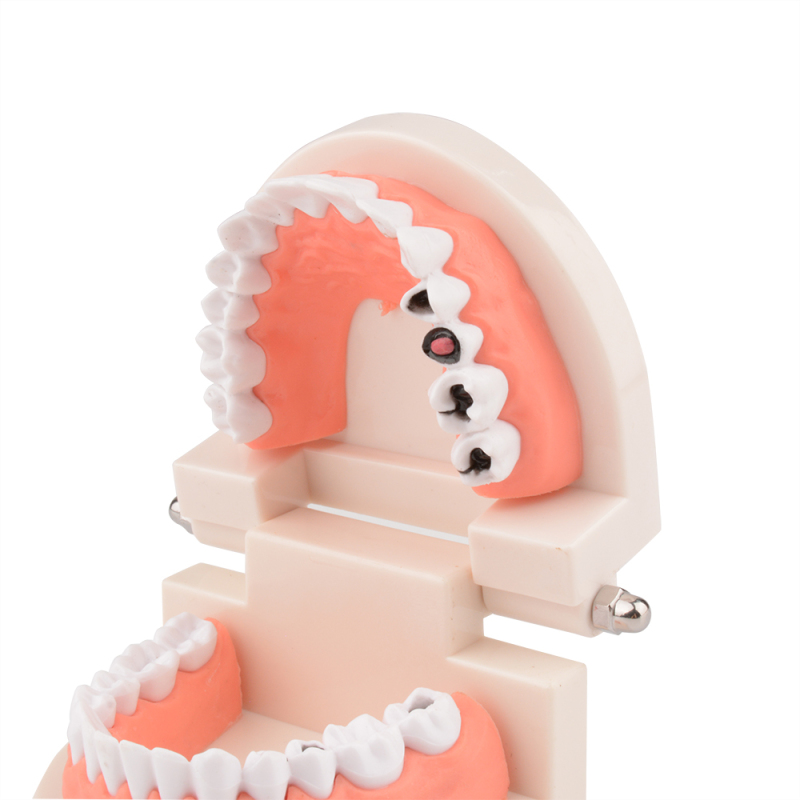 Standard Dental Tooth Decay Study Model, 1:1 Life Size Child