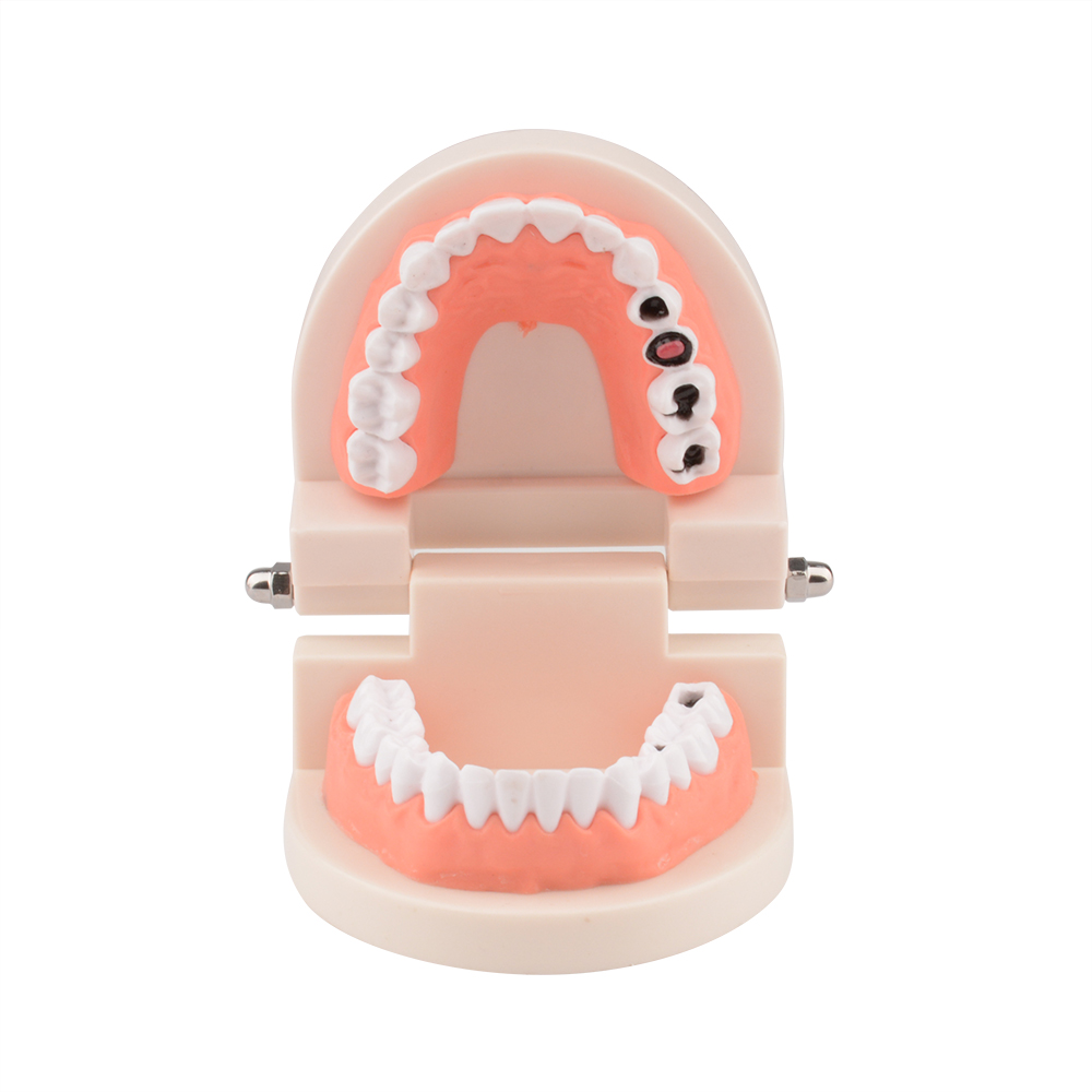 Standard Dental Tooth Decay Study Model, 1:1 Life Size Child