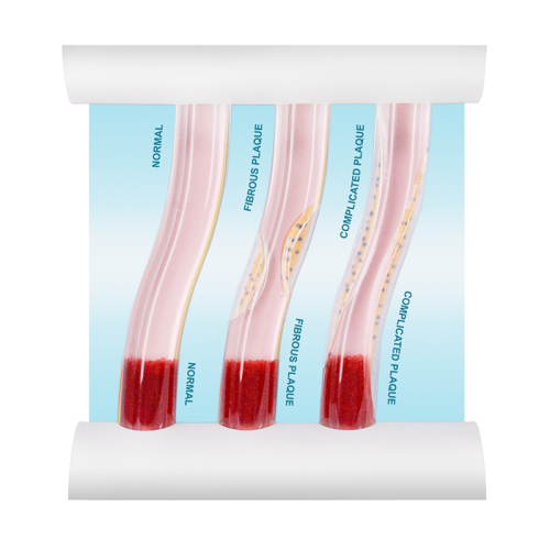 Dynamic Blood Vessel, Normal &amp; Atherosclerosis Model for Education