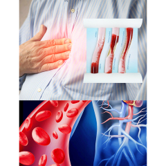 Dynamic Blood Vessel, Normal & Atherosclerosis Model for Education