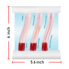 Dynamic Blood Vessel, Normal & Atherosclerosis Model for Education