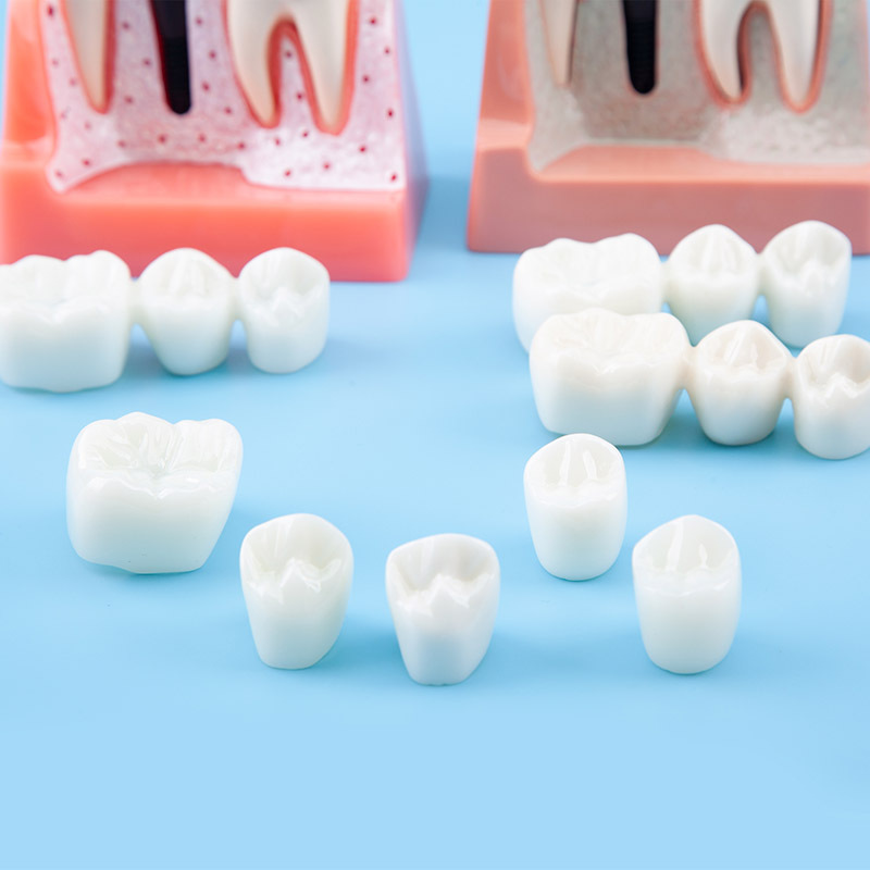 Removal Implant Teeth Model, 4 Times for Patient Education