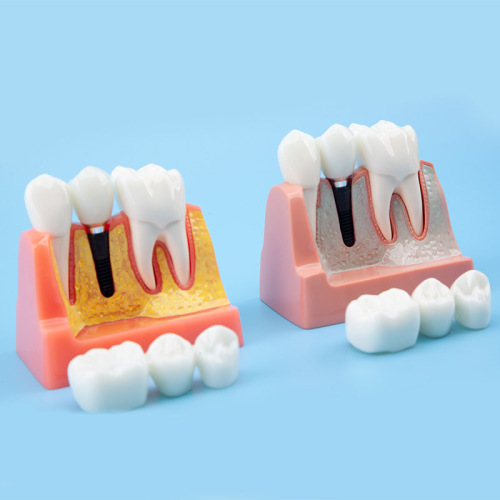 Removal Implant Teeth Model, 4 Times for Patient Education