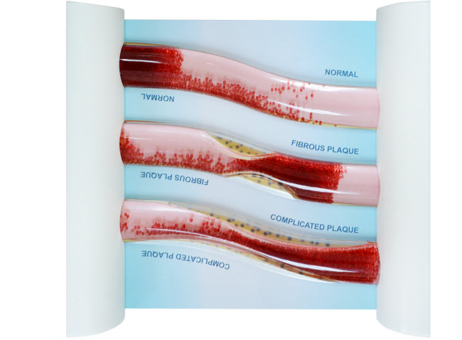 Low-Density Lipoprotein LDL Blood Vessel Comparison Model