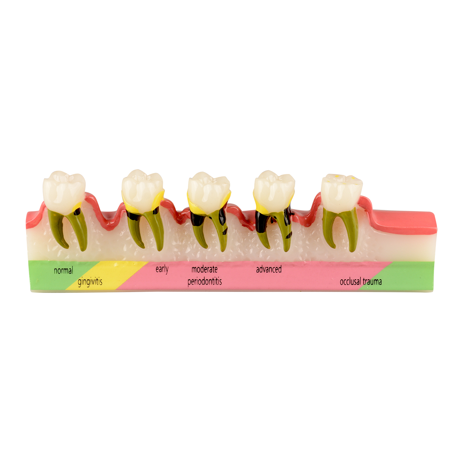 Periodontal Disease Classification Model